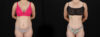 Tummy Tuck case #256517 slider thumbnail