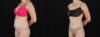 Tummy Tuck case #256517 slider thumbnail