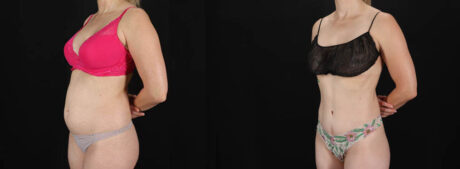 Tummy Tuck case #256517