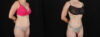 Tummy Tuck case #256517 slider thumbnail