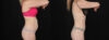Tummy Tuck case #256517 slider thumbnail
