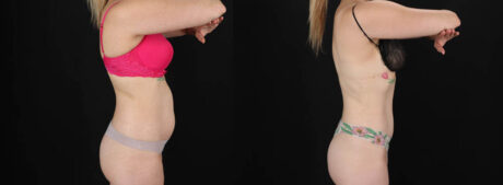 Tummy Tuck case #256517