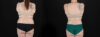 Tummy Tuck case #256538 slider thumbnail