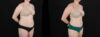 Tummy Tuck case #256538 slider thumbnail