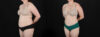 Tummy Tuck case #256538 slider thumbnail