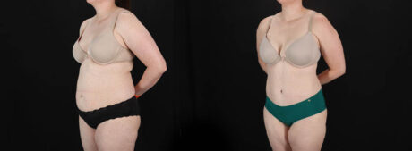 Tummy Tuck case #256538