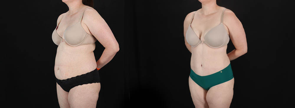 Tummy Tuck case #256538