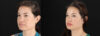 Skin Pen Microneedling case #256549 slider thumbnail