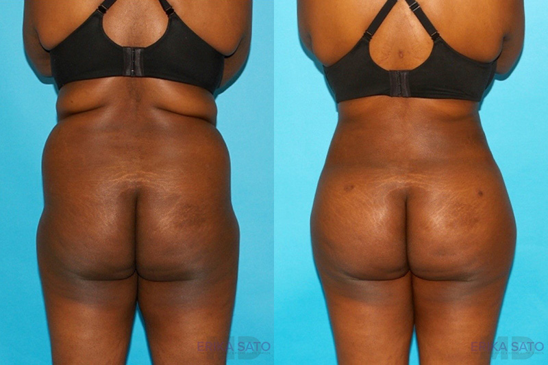 Brazilian Butt Lift case #256576