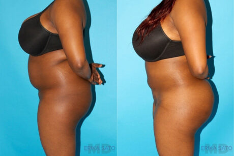 Brazilian Butt Lift case #256576