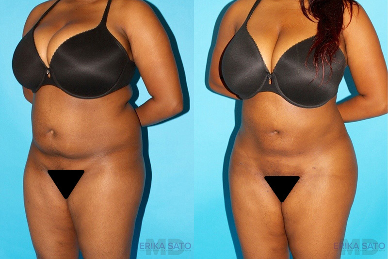 Brazilian Butt Lift case #256576