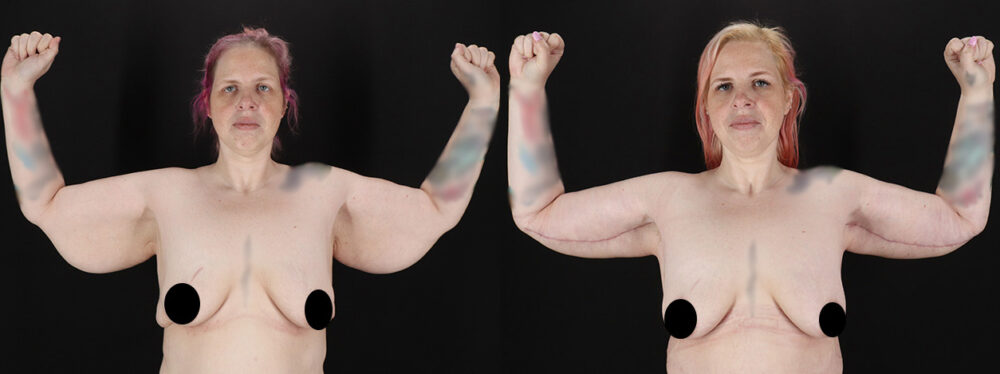 Arm Lift case #256569