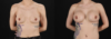 Breast Augmentation case #6444 slider thumbnail