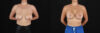 Breast Lift with Implants case #256828 slider thumbnail