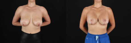 Breast Lift with Implants case #256828