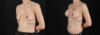 Breast Augmentation case #6444 slider thumbnail