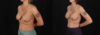 Revision Breast Surgery case #257422 slider thumbnail