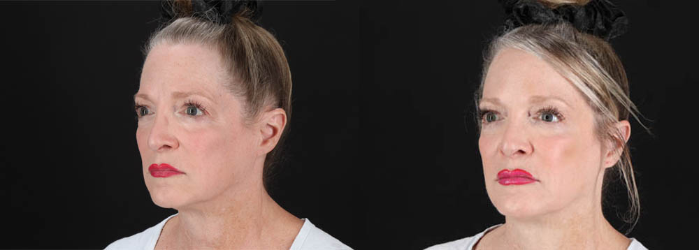 Botox® & Other Neuromodulators case #257429