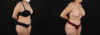 Tummy Tuck case #7618 slider thumbnail
