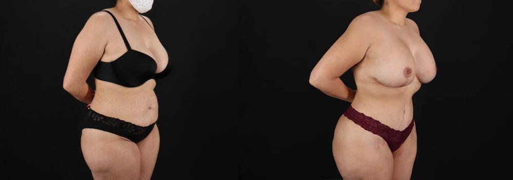 Tummy Tuck case #7618