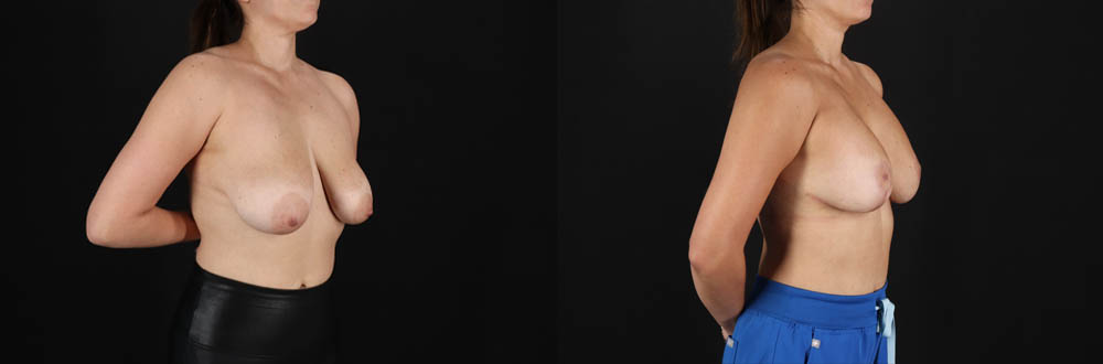 Breast Lift with Implants case #256828