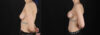 Breast Augmentation case #6444 slider thumbnail