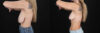 Breast Lift case #7826 slider thumbnail