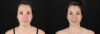Renuvion RF Skin Tightening case #257416 slider thumbnail