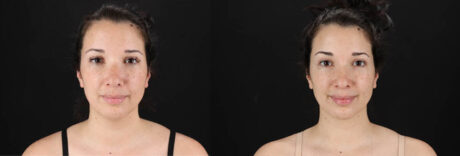 Renuvion RF Skin Tightening case #257416