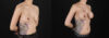 Breast Augmentation case #6444 slider thumbnail