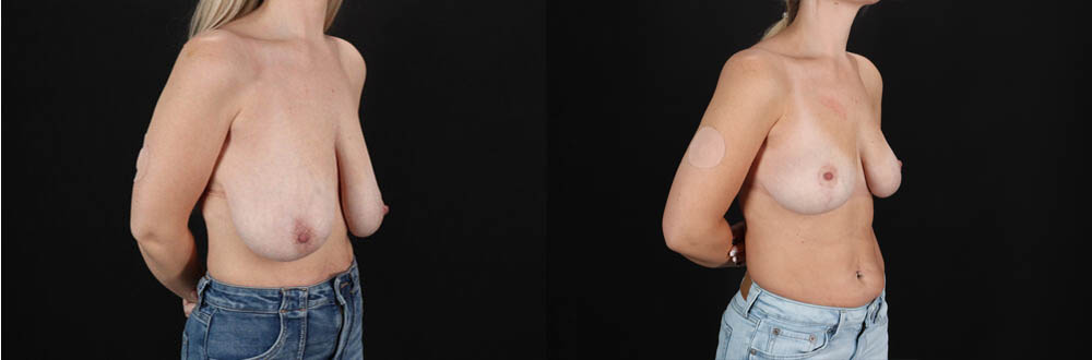 Breast Lift case #7826