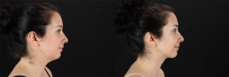 Renuvion RF Skin Tightening case #257416