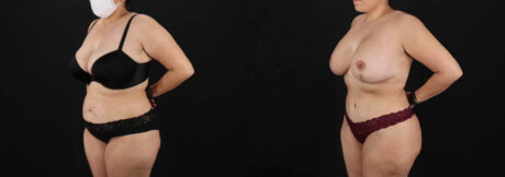 Tummy Tuck case #7618