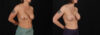 Revision Breast Surgery case #257422 slider thumbnail