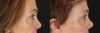 Blepharoplasty case #6889 slider thumbnail