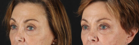 Blepharoplasty case #6889