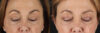 Blepharoplasty case #6889 slider thumbnail
