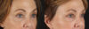 Blepharoplasty case #6889 slider thumbnail