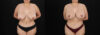 Revision Breast Surgery case #256503 slider thumbnail