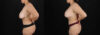 Revision Breast Surgery case #256503 slider thumbnail