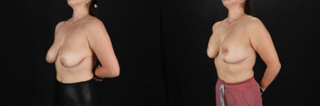 Breast Lift with Implants case #256828