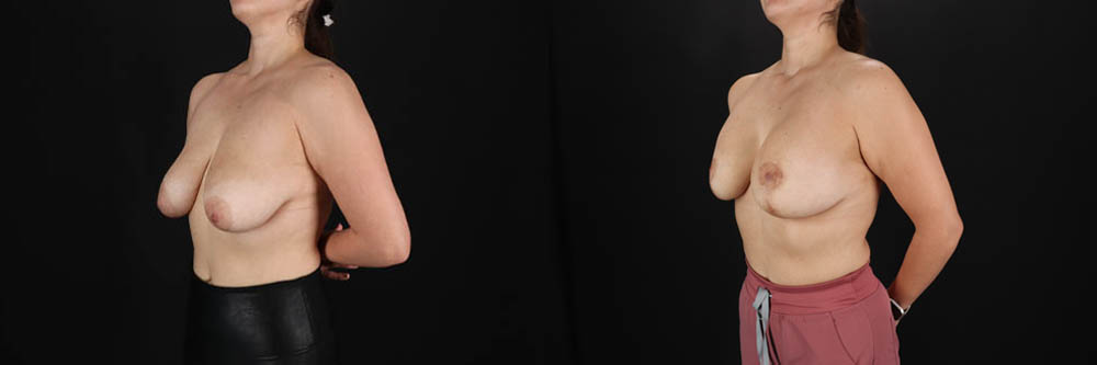 Breast Lift with Implants case #256828