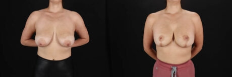 Breast Lift with Implants case #256828