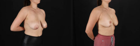 Breast Lift with Implants case #256828