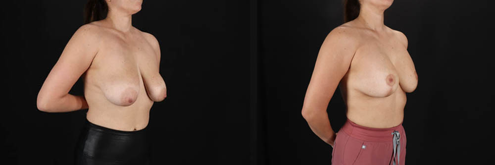 Breast Lift with Implants case #256828