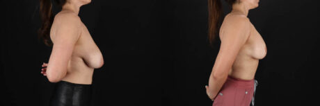 Breast Lift with Implants case #256828