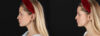 Skin Pen Microneedling case #258899 slider thumbnail