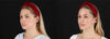Skin Pen Microneedling case #258899 slider thumbnail