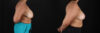 Breast Reduction case #258846 slider thumbnail
