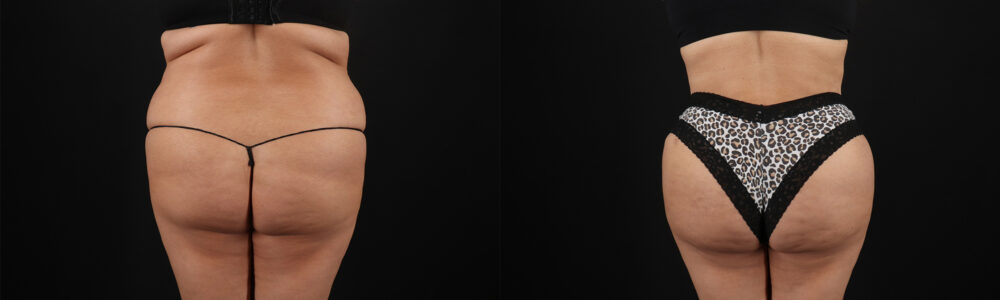 Tummy Tuck case #259095